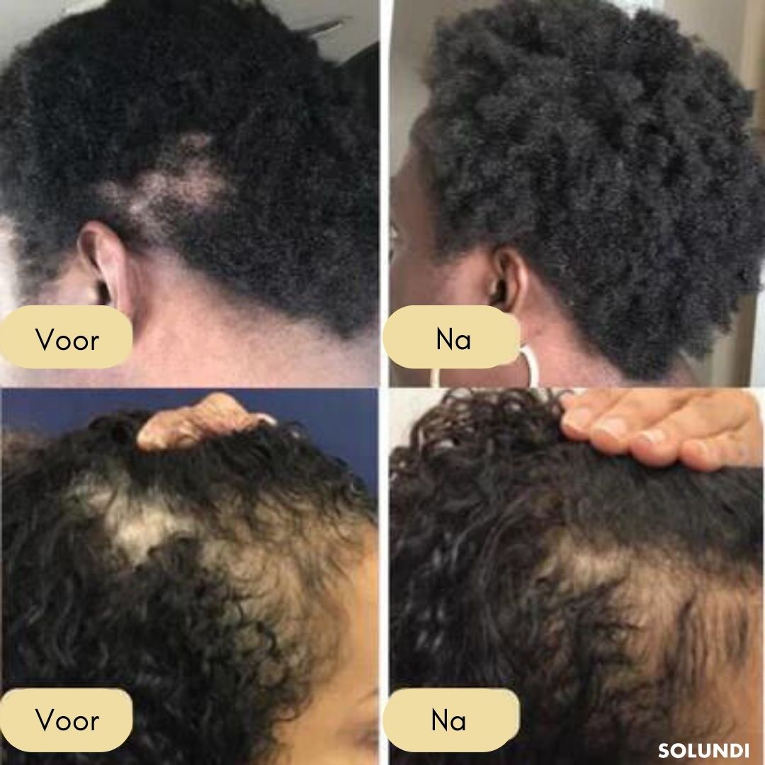 VitalGrow™ NEW EDITION | Jouw natuurlijke oliebehandeling voor haargroei