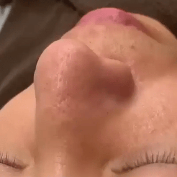 TIJDELIJK 50% KORTING DermaVeo™