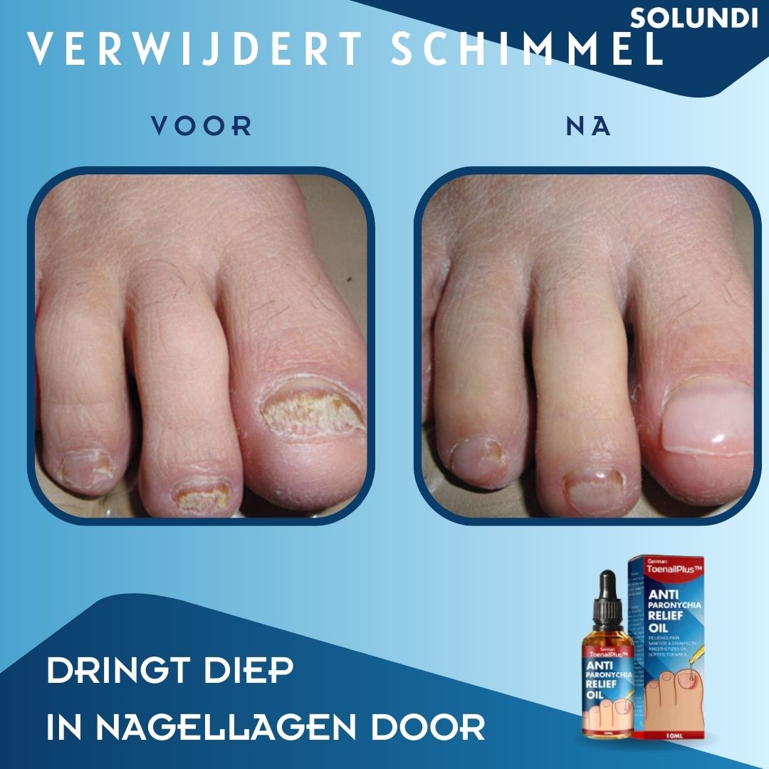 50% OFF VANDAAG | ToePerfect™ - Serum voor gezonde teennagels