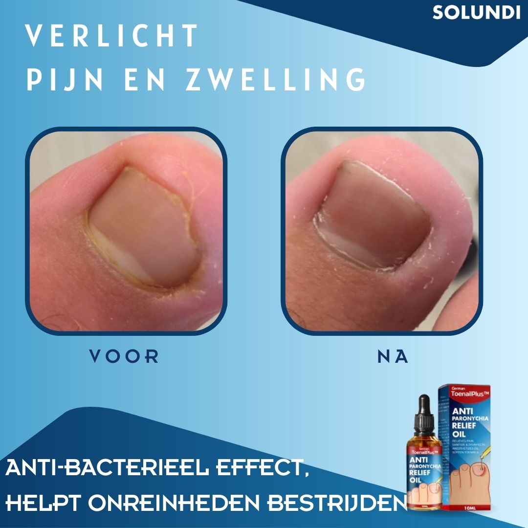 50% OFF VANDAAG | ToePerfect™ - Serum voor gezonde teennagels