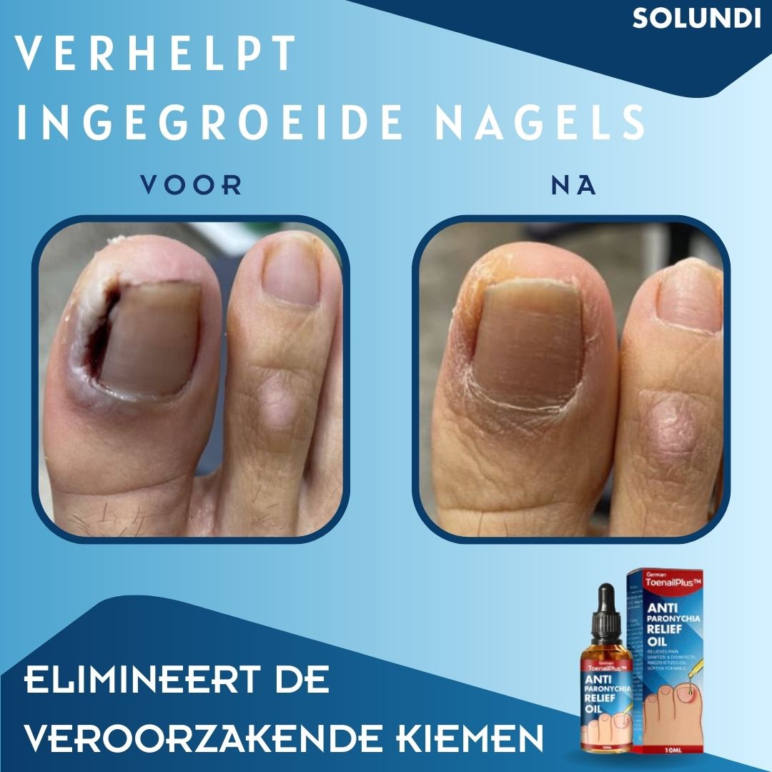 50% OFF VANDAAG | ToePerfect™ - Serum voor gezonde teennagels