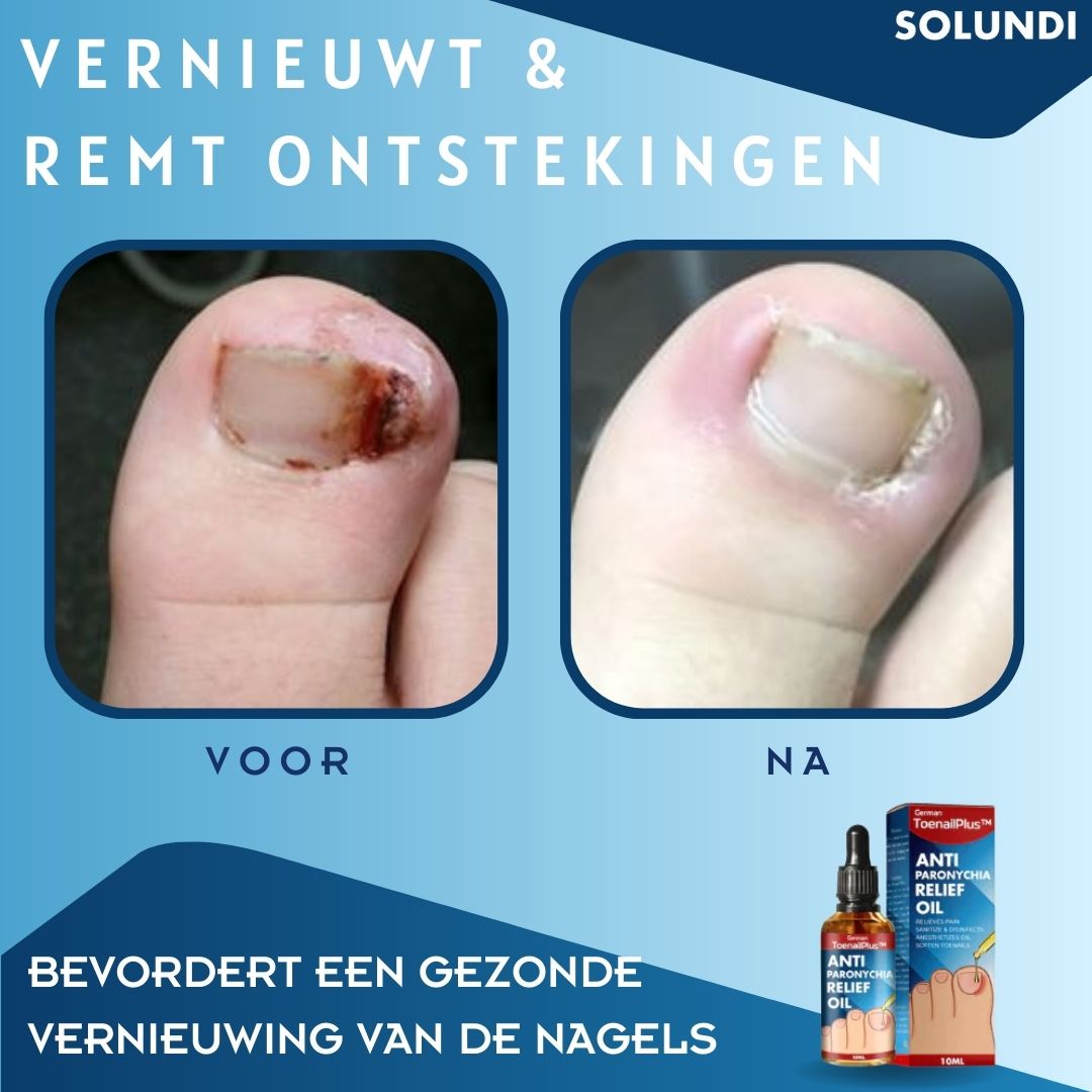 50% OFF VANDAAG | ToePerfect™ - Serum voor gezonde teennagels