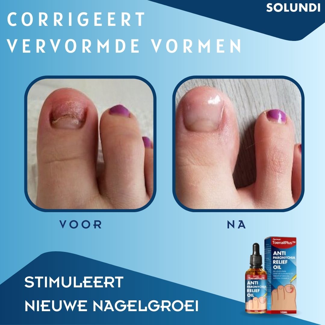 50% OFF VANDAAG | ToePerfect™ - Serum voor gezonde teennagels