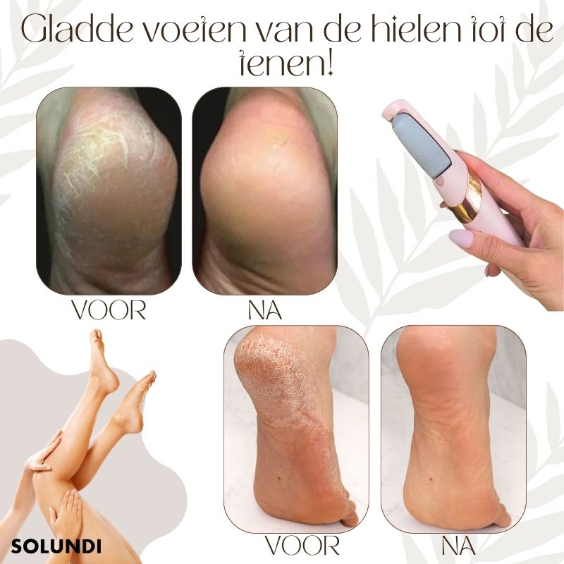 CallusMaster⢠- Elektrische eelttovenaar | 50% tijdelijke korting