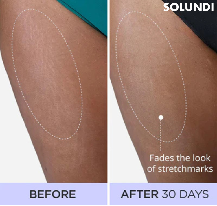 1+1 GRATIS VANDAAG | SmoothSculpt⢠| Zeg hallo tegen zichtbaar stevigere huid!