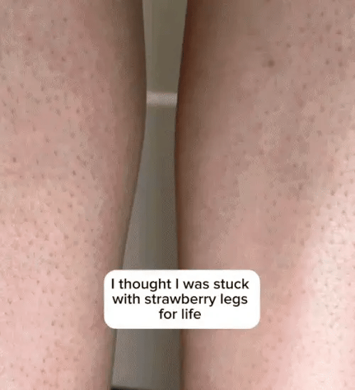 1 + 1 GRATIS VANDAAG DermaBareā¢