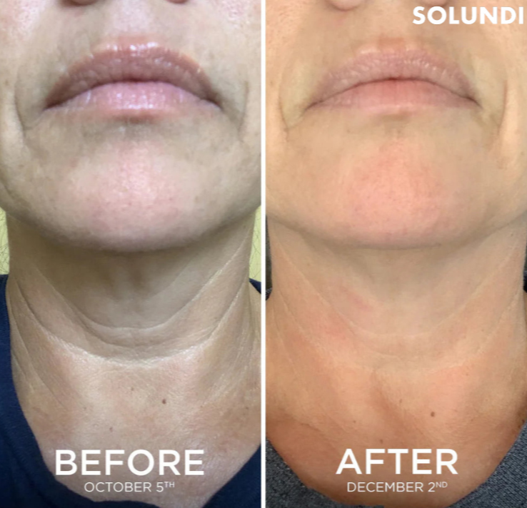 1+1 GRATIS VANDAAG | SmoothSculpt⢠| Zeg hallo tegen zichtbaar stevigere huid!