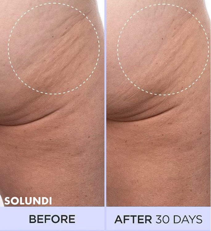 1+1 GRATIS VANDAAG | SmoothSculpt⢠| Zeg hallo tegen zichtbaar stevigere huid!