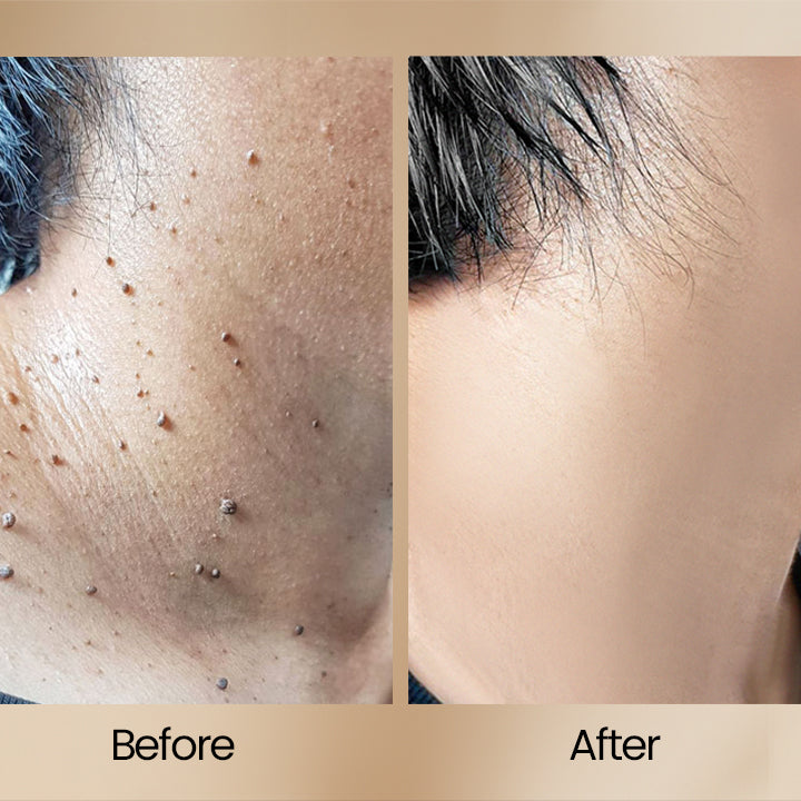 TIJDELIJK 1+1 GRATIS | ClearSkin™ | Bijengif Wrattenverwijderingsspray