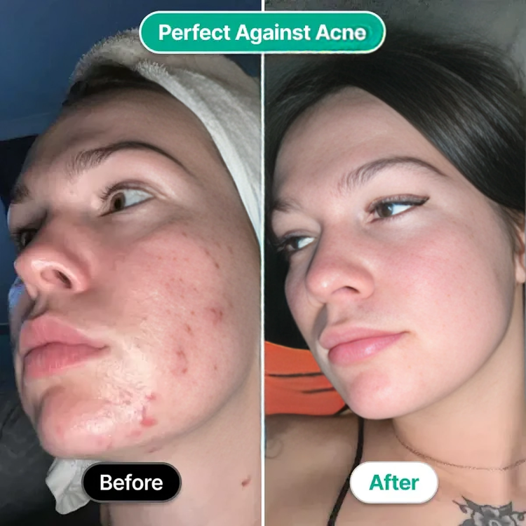 AcneZap⢠| Hoogfrequent gezichtsstaaf