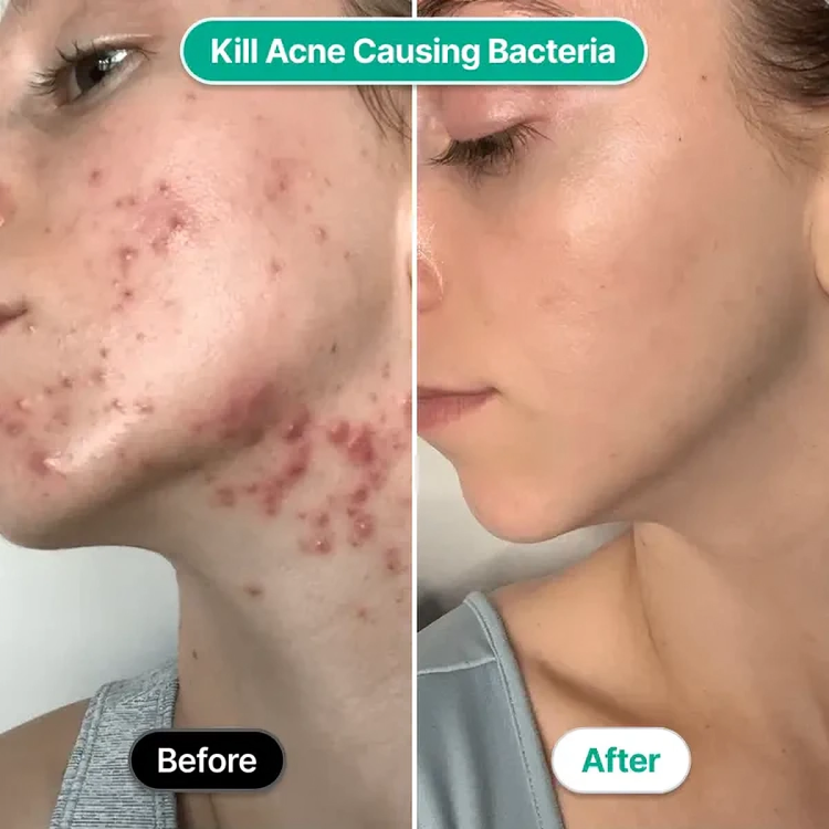 AcneZap⢠| Hoogfrequent gezichtsstaaf