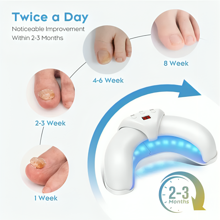 NailRenew™ | Bestrijd en elimineer schimmelnagels!