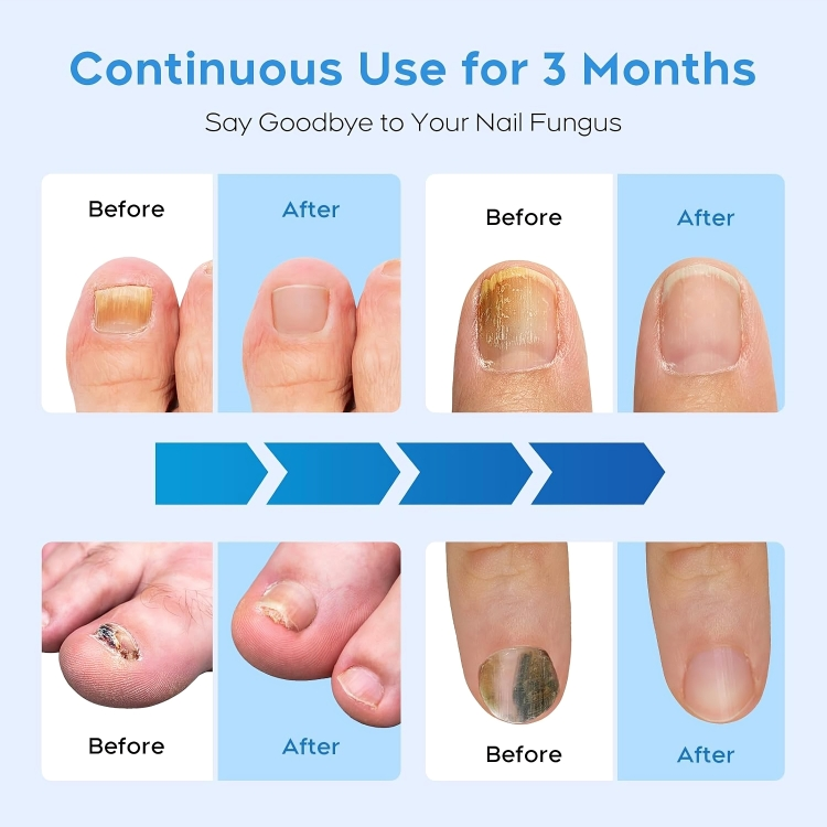 NailRenew™ | Bestrijd en elimineer schimmelnagels!