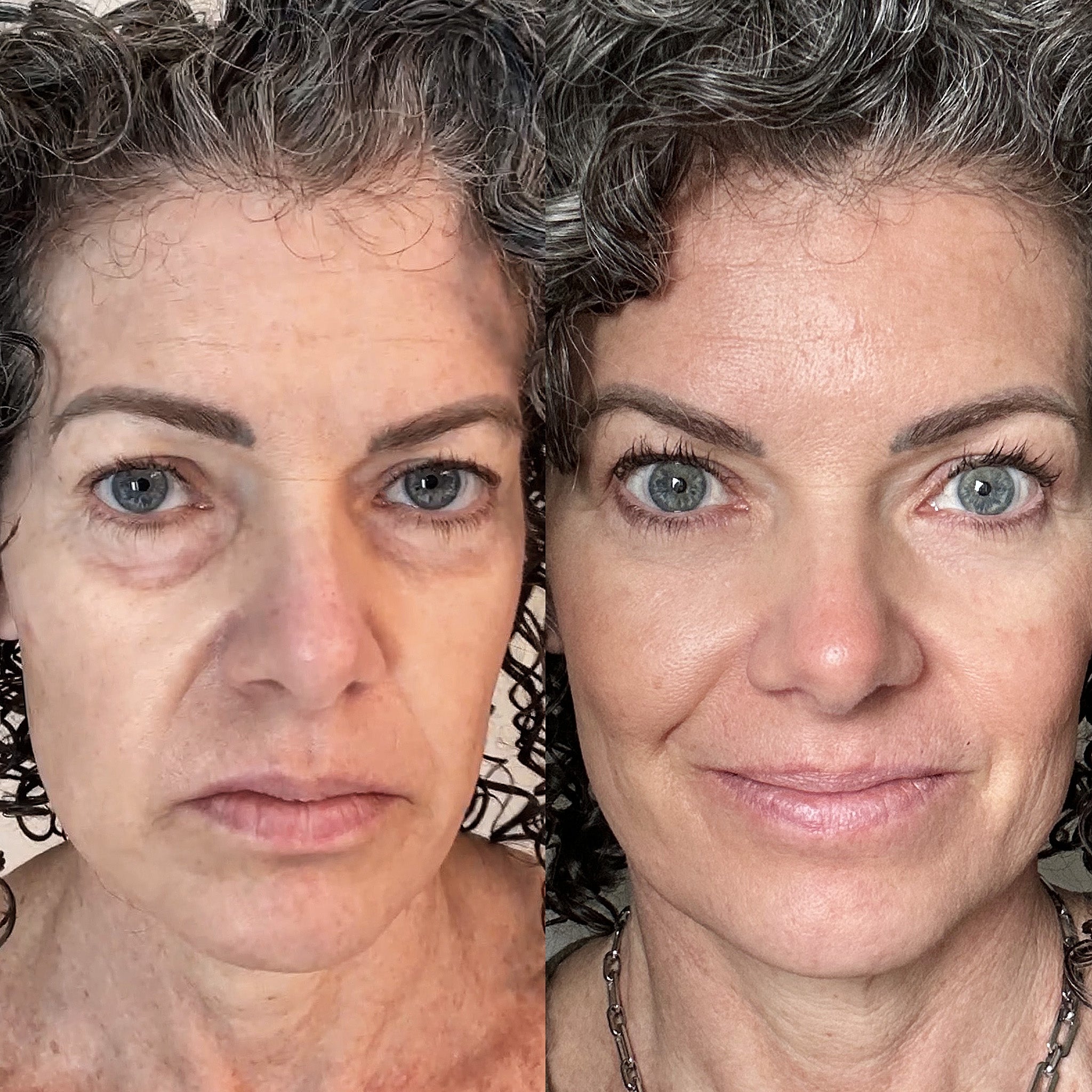 EyeRevive™ | Zeg maar dag tegen donkere kringen en wallen!