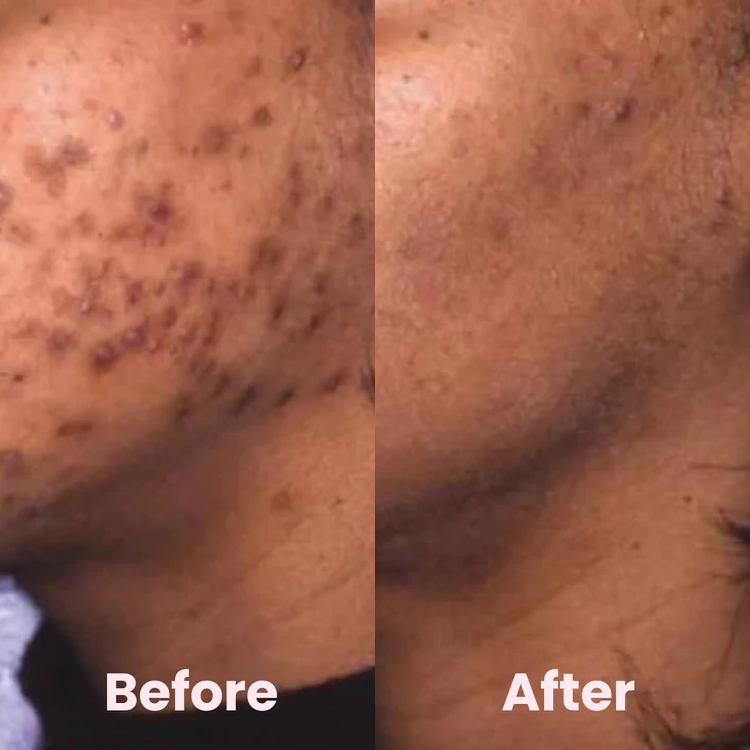 RadiancePads⢠| Kurkuma en kojinezuur pads