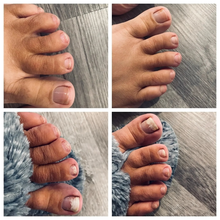 NailRenew™ | Bestrijd en elimineer schimmelnagels!