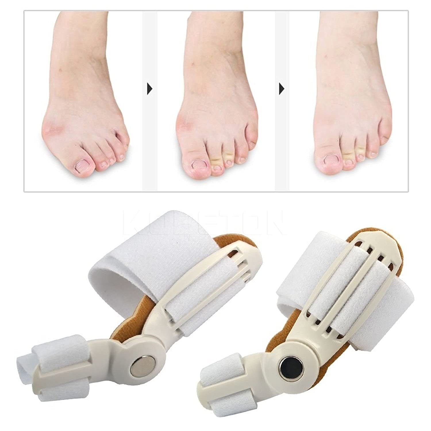 Verstelbare Teencorrector tegen Bunion – foto 2