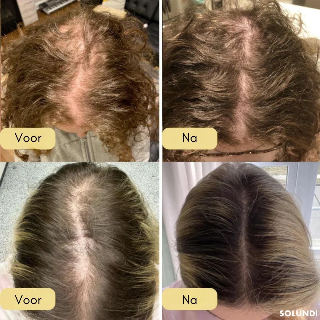VitalGrow™ NEW EDITION | Jouw natuurlijke oliebehandeling voor haargroei