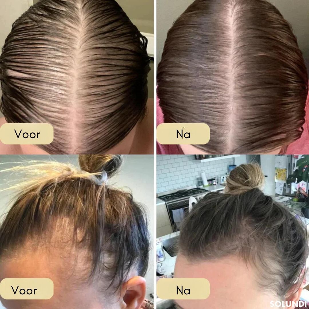 VitalGrow™ NEW EDITION | Jouw natuurlijke oliebehandeling voor haargroei