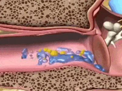 TIJDELIJK 50% KORTING  EarVac™ 