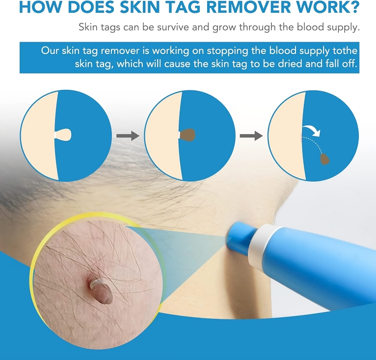 TagErase™ | Verwijder skin tags snel en veilig!