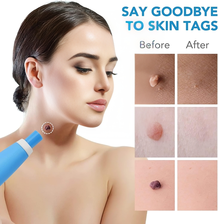 TagErase™ | Verwijder skin tags snel en veilig!