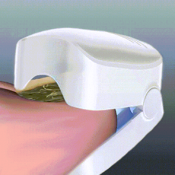 TIJDELIJK 50% KORTING  NailCure™