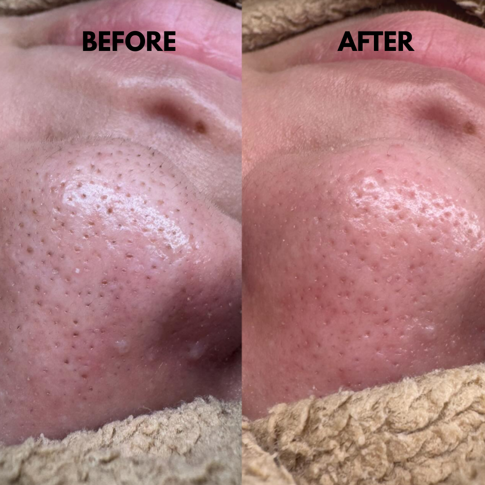 TIJDELIJK 50% KORTING | SkinSonic™