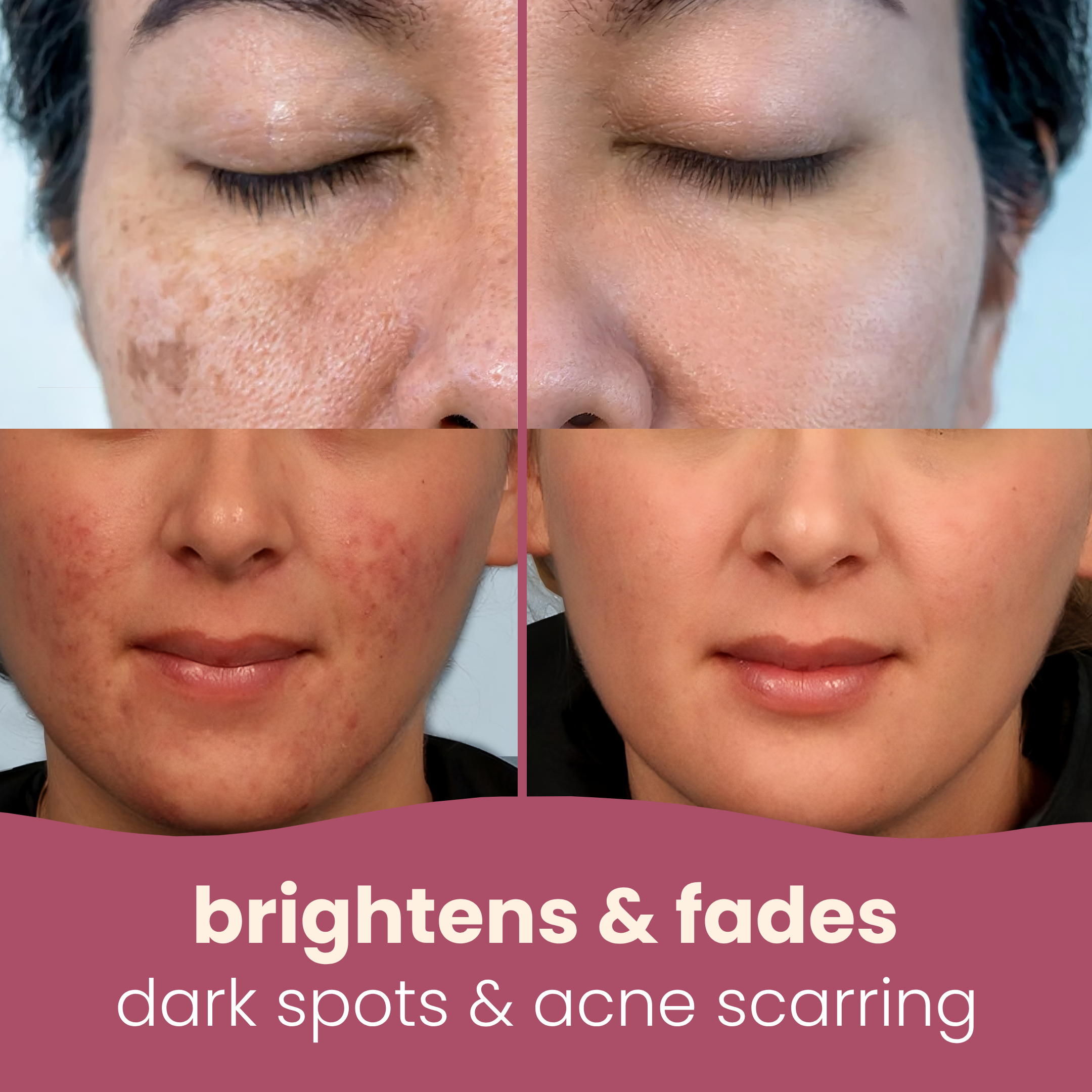 TIJDELIJK 50% KORTING | SpotFade™ - Verhelderende pads