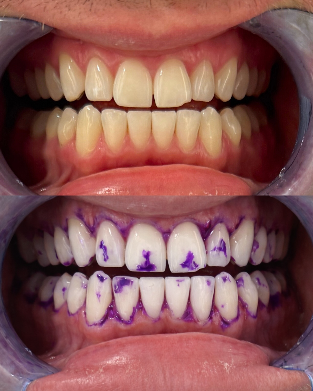 1 + 1 GRATIS VANDAAG | Smilekit - Tandenbleekstrips