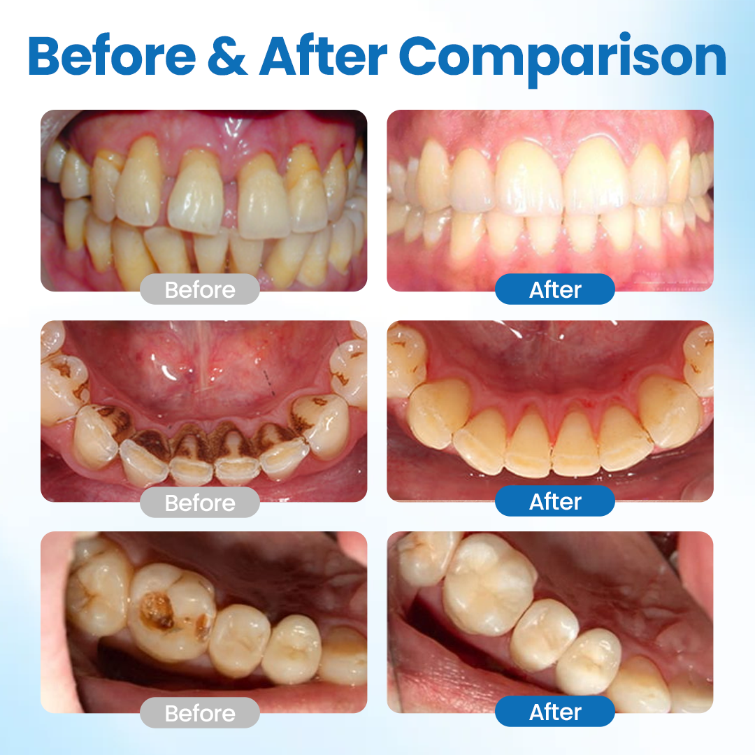 1 + 1 GRATIS VANDAAG | ToothArmor™