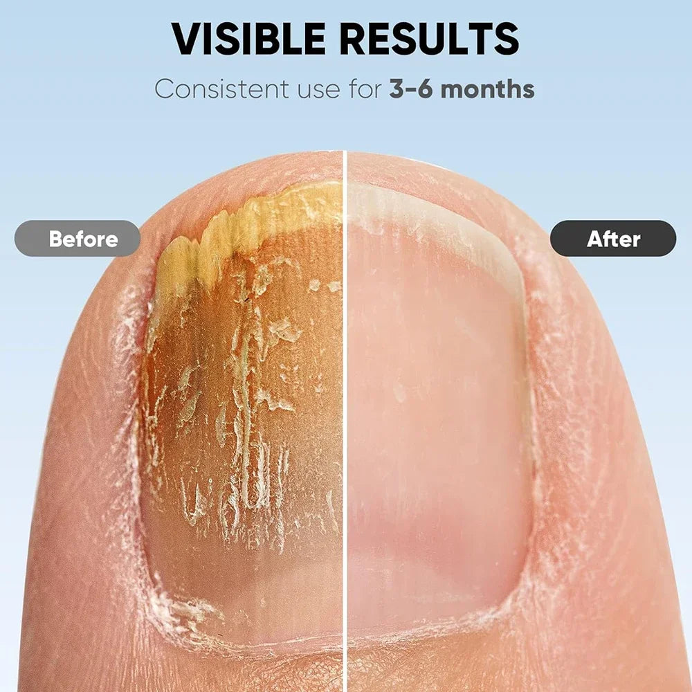 TIJDELIJK 50% KORTING | NailCure™