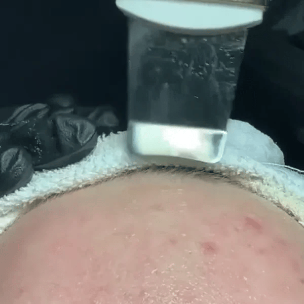 TIJDELIJK 50% KORTING  SkinSonic™